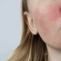 Jak zaradzić problemowi z Trądzikiem różowatym za pomocą Totalnej Biologii